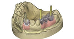 CAD Design Software exocad Implant - Neo Dens